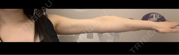 額を丸く / 脂肪吸引（二の腕） / 脂肪注入（額） AVAN TOKYO 銀座脂肪吸引 クリニック DAY 92 メイン用
