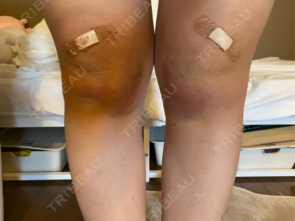 その他（ボディ） イテウォンビューティークリニック 大阪心斎橋院 DAY 5 メイン用