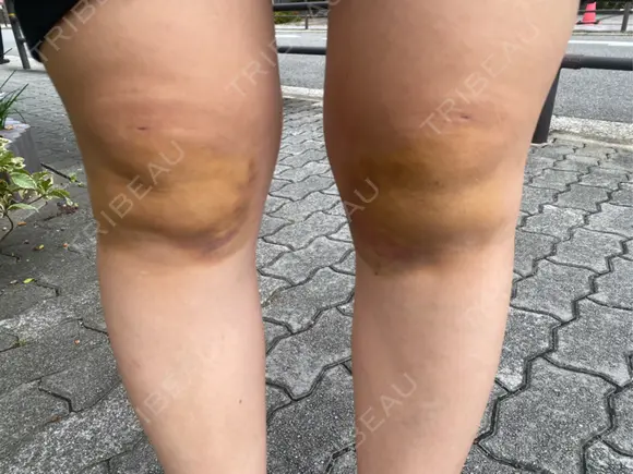 その他（ボディ） イテウォンビューティークリニック 大阪心斎橋院 DAY 6 メイン用