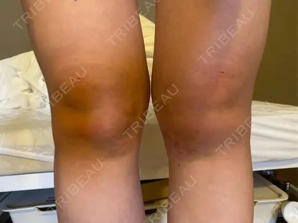 その他（ボディ） イテウォンビューティークリニック 大阪心斎橋院 DAY 12 メイン用