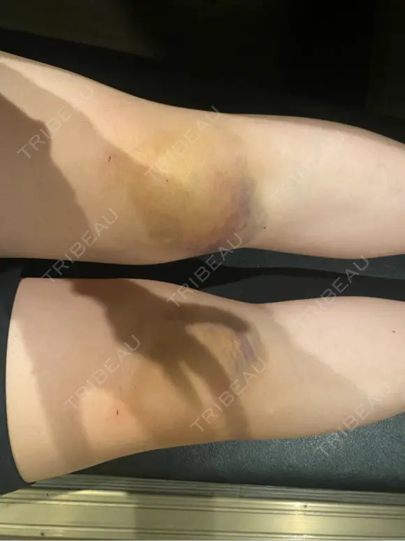 その他（ボディ） イテウォンビューティークリニック 大阪心斎橋院 DAY 16 メイン用