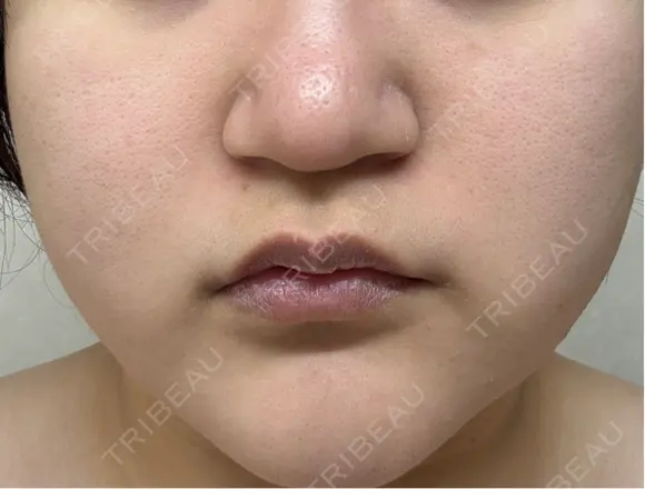 脂肪溶解注射（顔） ミニマムスキンクリニック池袋 DAY 1 メイン用