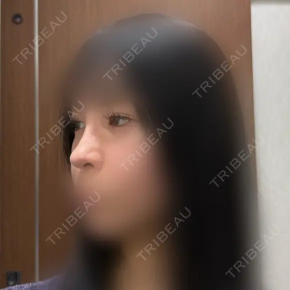 目頭切開 / 小鼻縮小（切開） / 鼻尖形成（非切開） アネシス美容クリニック DAY 286 メイン用