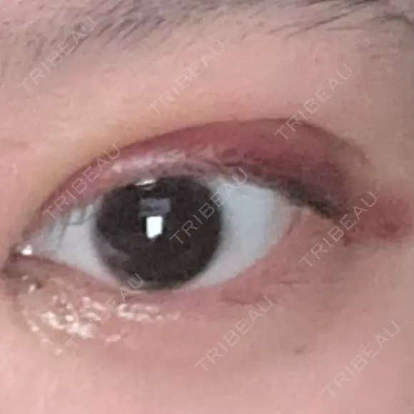 二重埋没 / 目頭切開 / 上まぶたの脂肪取り 9BeautyClinic AFTER メイン用