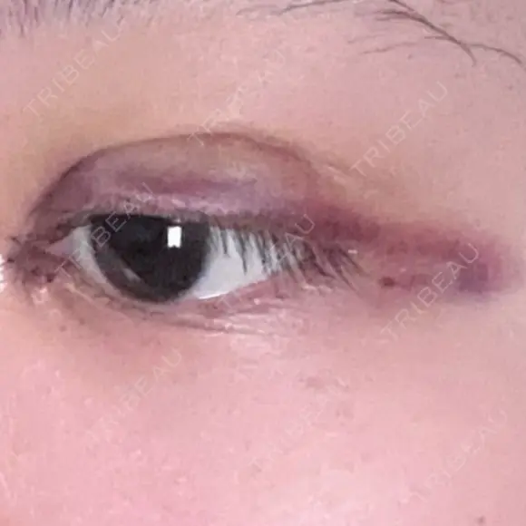 二重埋没 / 目頭切開 / 上まぶたの脂肪取り 9BeautyClinic DAY 3 メイン用