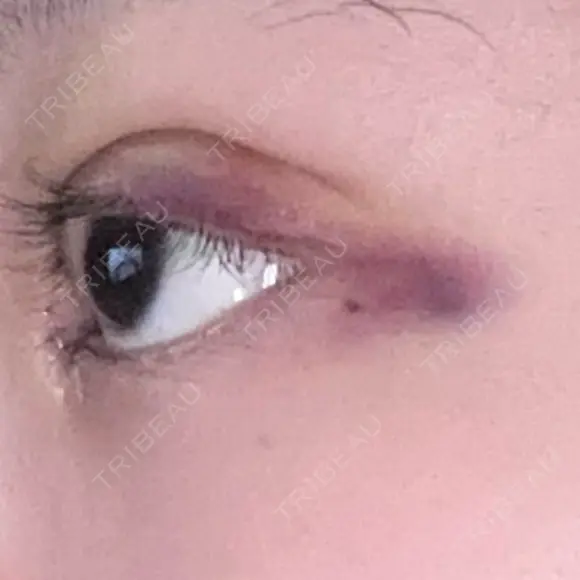 二重埋没 / 目頭切開 / 上まぶたの脂肪取り 9BeautyClinic DAY 3 メイン用