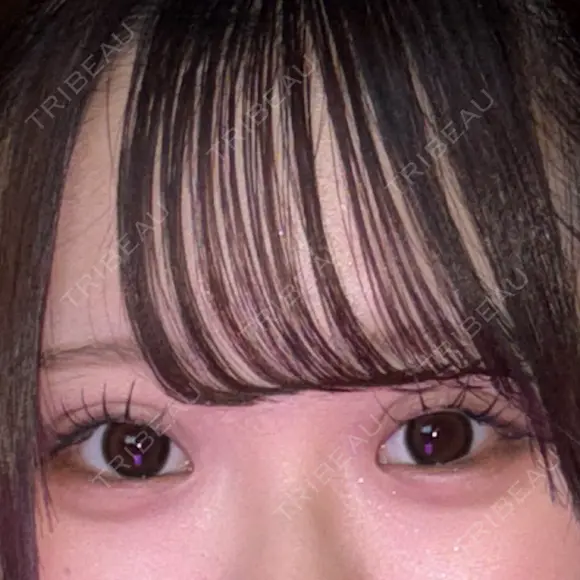 二重埋没 アリエル美容クリニック 大宮院 DAY 20 メイン用