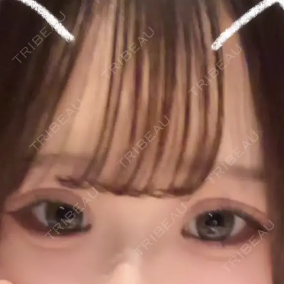 二重埋没 アリエル美容クリニック 大宮院 DAY 27 メイン用