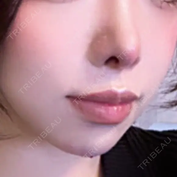 鼻尖形成（切開） / 糸リフト / 脂肪吸引（顔） / 軟骨移植 / 鼻柱下降・鼻唇角形成（猫手術） / ボトックス（エラ・小顔） eクリニック 名古屋院 DAY 27 メイン用