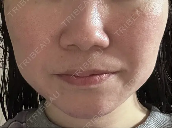 ピーリング（ニキビ・毛穴） / 美肌レーザー NEO Skin Clinic恵比寿 AFTER メイン用