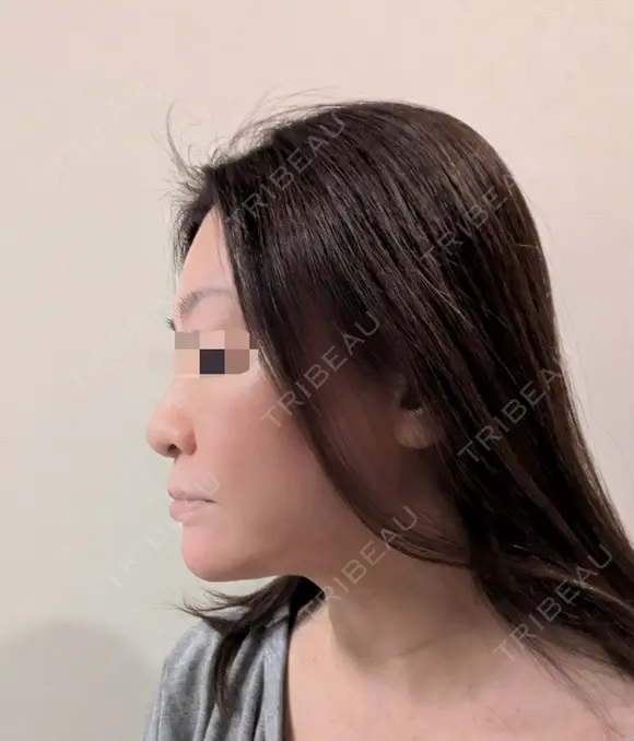 糸リフト / 脂肪吸引（顔） Wing clinic 豊中駅前院 DAY 38 メイン用