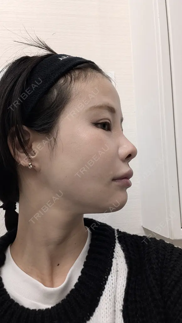 糸リフト / 脂肪吸引（顔） / その他（輪郭） / ジョールファット除去 WOM CLINIC GINZA （ワム クリニック ギンザ） DAY 47 メイン用