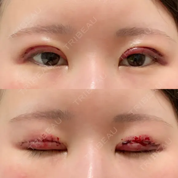 二重切開 東京エビスクリニック DAY 0 メイン用