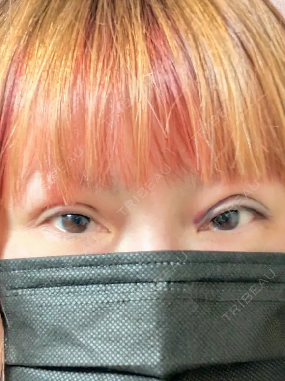 二重埋没 湘南美容クリニック 千葉センシティ院 DAY 1 メイン用