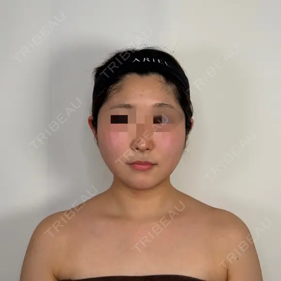 糸リフト / バッカルファット除去 / 脂肪吸引（顔） / ボトックス（あご） / ボトックス（エラ・小顔） アリエル美容クリニック 水戸院 DAY 14 メイン用
