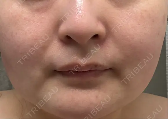 その他（肌） / シミ取りレーザー / ルメッカ ルラ美容クリニック 郡山院 DAY 44 メイン用