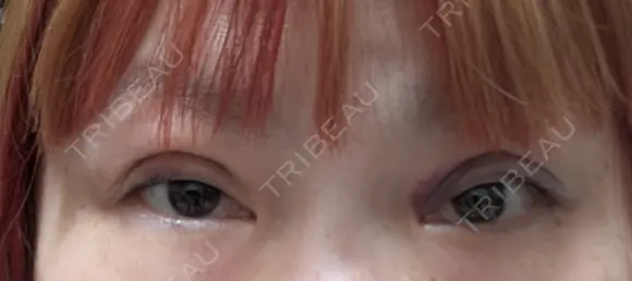 二重埋没 湘南美容クリニック 千葉センシティ院 DAY 2 メイン用