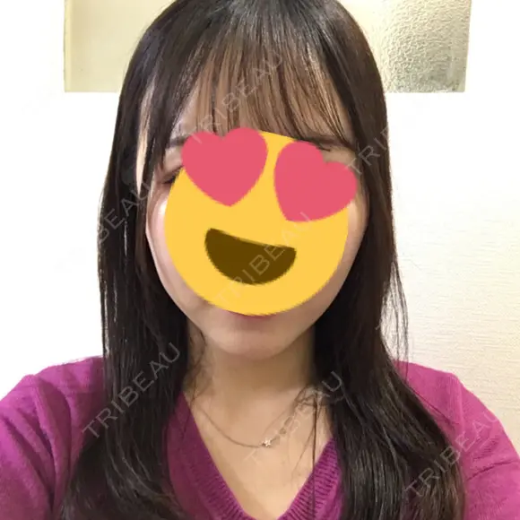 バッカルファット除去 / 脂肪吸引（顔） / ボトックス（エラ・小顔） / ヒアルロン酸注入（額） エートップ美容整形外科 DAY 96 メイン用