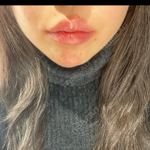 ボトックス（あご） / ヒアルロン酸注入（あご） / ヒアルロン酸注入（唇） HAAB×DREAM BEAUTY CLINIC 大阪梅田院 DAY 0 メイン用