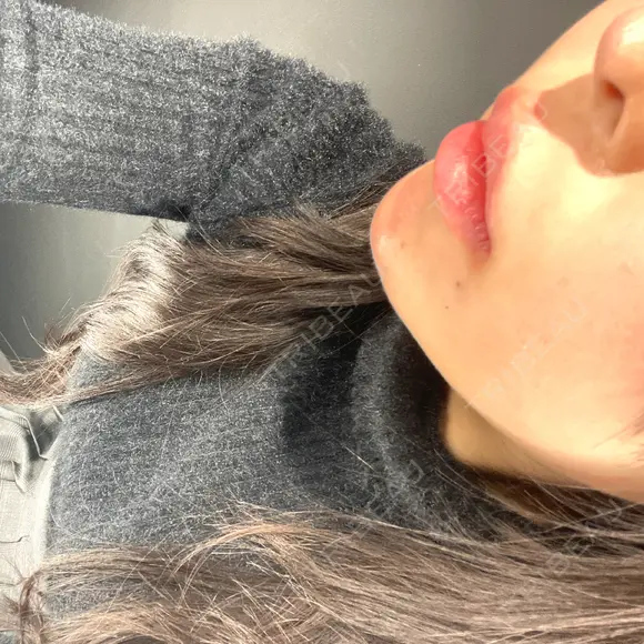 ボトックス（あご） / ヒアルロン酸注入（あご） / ヒアルロン酸注入（唇） HAAB×DREAM BEAUTY CLINIC 大阪梅田院 DAY 0 メイン用