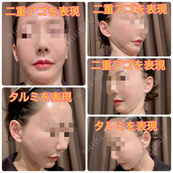 バッカルファット除去 / その他（輪郭） / 切開リフト / メーラーファット除去 / ジョールファット除去 / あご下筋肉縛り / ネックリフト / ヒアルロン酸注入（頬） / ヒアルロン酸注入（首） タシピウム整形外科 DAY 334 メイン用