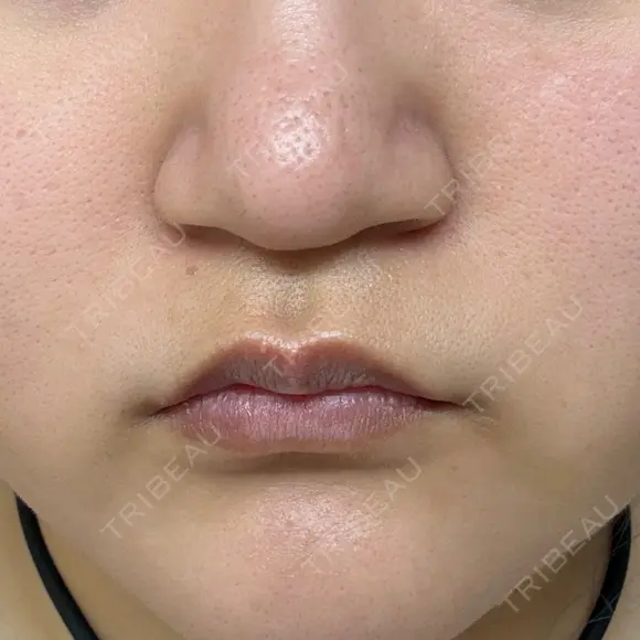 脂肪溶解注射（顔） ミニマムスキンクリニック池袋 DAY 4 メイン用