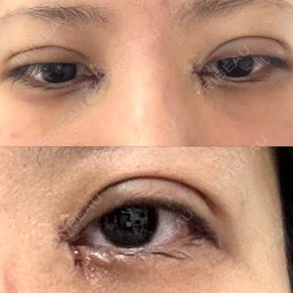 二重埋没 / 目頭切開 BITO BEAUTY CLINIC AFTER メイン用