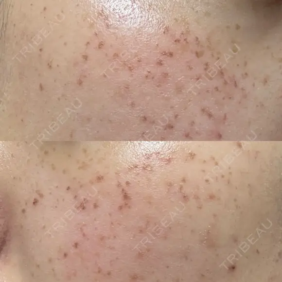 ピーリング（ニキビ・毛穴） / イオン導入 / ルメッカ ルラ美容クリニック 札幌本院 DAY 0 メイン用