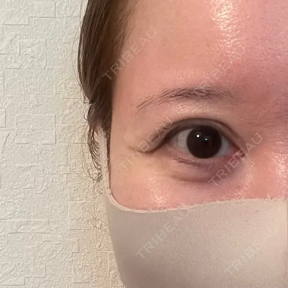 下まぶたたるみ取り / その他（目元） ネビュラクリニック 京都院 DAY 93 メイン用