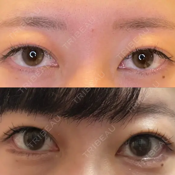 脂肪吸引（顔） / 目尻切開 / タレ目形成・グラマラスライン（埋没） LOUIS CLINIC 二子玉川院【ルイクリニック】 AFTER メイン用