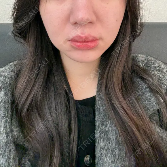 糸リフト / バッカルファット除去 / 脂肪吸引（顔） / メーラーファット除去 / ジョールファット除去 / 脂肪注入（輪郭） First Clinic AFTER メイン用