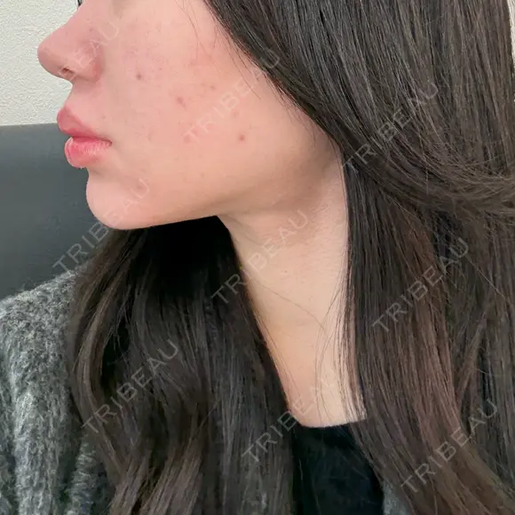 糸リフト / バッカルファット除去 / 脂肪吸引（顔） / メーラーファット除去 / ジョールファット除去 / 脂肪注入（輪郭） First Clinic DAY 106 メイン用