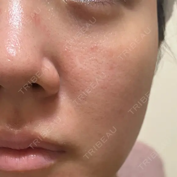 ヴェルヴェットスキン 形成外科と美容外科のクリニック池袋 DAY 43 メイン用