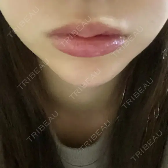 ボトックス（あご） / ヒアルロン酸注入（あご） HAAB BEAUTY CLINIC 名古屋院 DAY 0 メイン用
