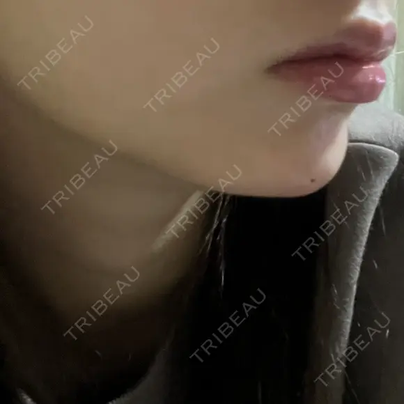 ボトックス（あご） / ヒアルロン酸注入（あご） HAAB BEAUTY CLINIC 名古屋院 DAY 0 メイン用