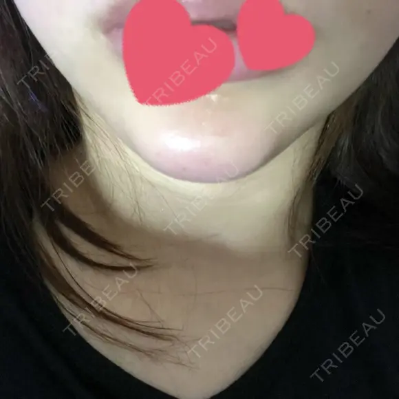 ボトックス（あご） / ヒアルロン酸注入（あご） HAAB BEAUTY CLINIC 名古屋院 DAY 1 メイン用