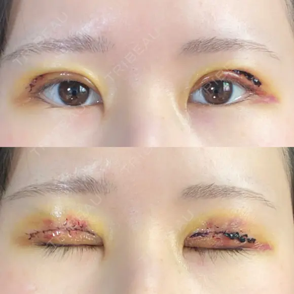 二重切開 東京エビスクリニック DAY 3 メイン用