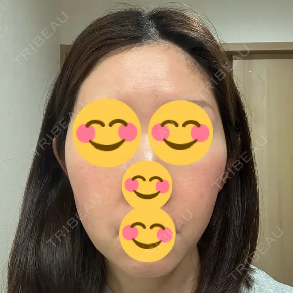 インモード Moon Beauty Clinic DAY 5 メイン用