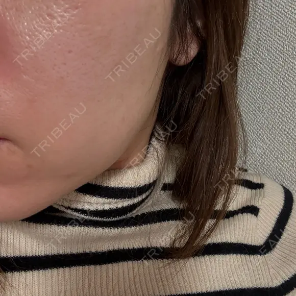 ピーリング（ニキビ・毛穴） / LDM・インテンスウルトラ ライズワン美容皮膚科クリニック DAY 0 メイン用