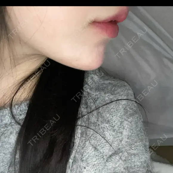 ボトックス（あご） / ヒアルロン酸注入（あご） / ヒアルロン酸注入（唇） HAAB×DREAM BEAUTY CLINIC 大阪梅田院 DAY 1 メイン用