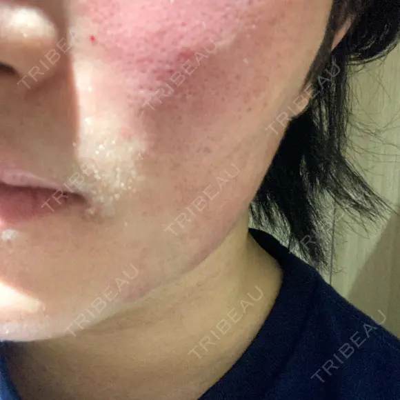 フラクショナルレーザー（毛穴・ニキビ跡） ルラ美容クリニック 大阪本院 DAY 1 メイン用