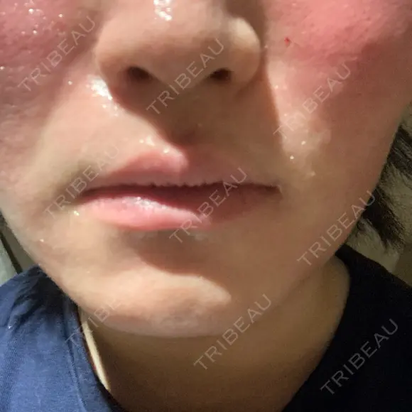 フラクショナルレーザー（毛穴・ニキビ跡） ルラ美容クリニック 大阪本院 DAY 1 メイン用