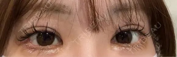 目尻切開 / タレ目形成・グラマラスライン（埋没） LOUIS CLINIC 二子玉川院【ルイクリニック】 DAY 2 メイン用