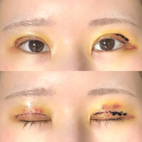 二重切開 東京エビスクリニック DAY 4 メイン用