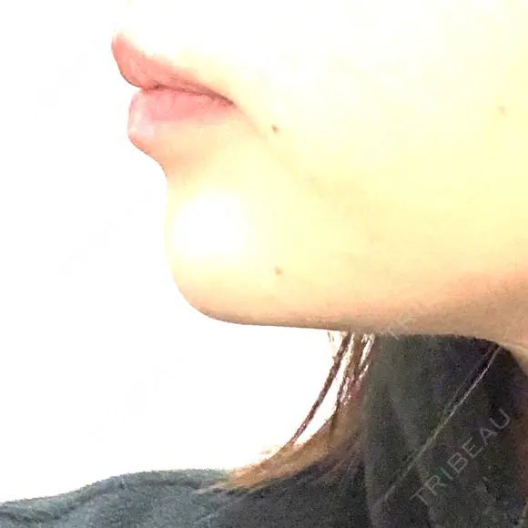ボトックス（あご） / 肌ヒアルロン酸注入（たるみ・シワ改善） BIZENNクリニック【ビゼンクリニック】 DAY 30 メイン用