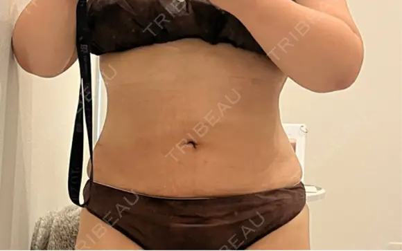 医療痩身（お腹） 渋谷美容外科クリニック 渋谷院 AFTER メイン用