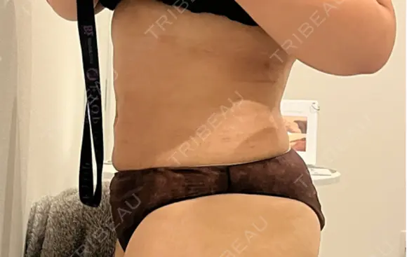 医療痩身（お腹） 渋谷美容外科クリニック 渋谷院 DAY 46 メイン用