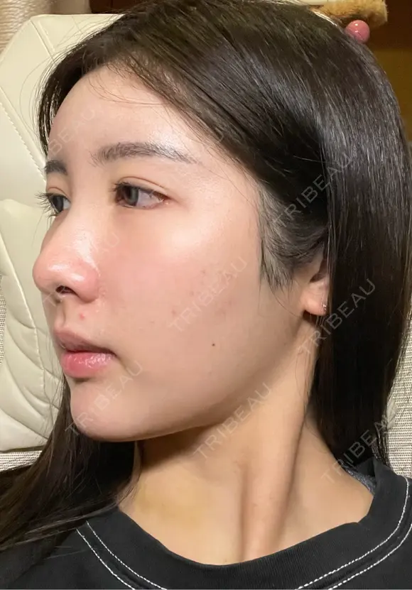 糸リフト / バッカルファット除去 / 脂肪吸引（顔） / 脂肪注入（額） / ジョールファット除去 First Clinic AFTER メイン用