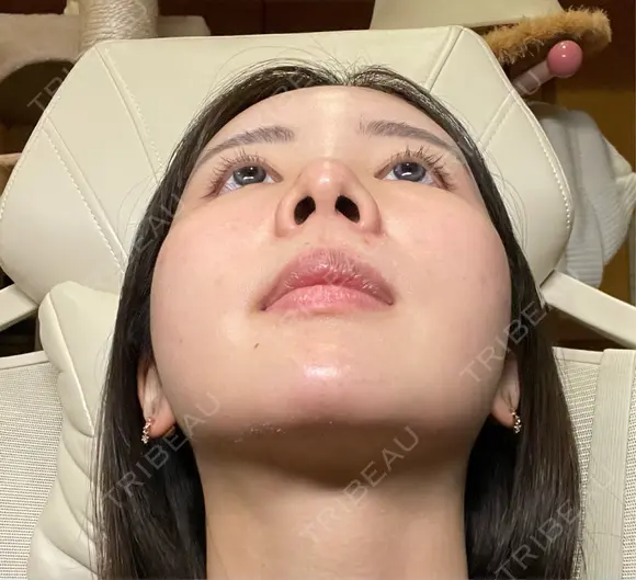 糸リフト / バッカルファット除去 / 脂肪吸引（顔） / 脂肪注入（額） / ジョールファット除去 First Clinic DAY 14 メイン用