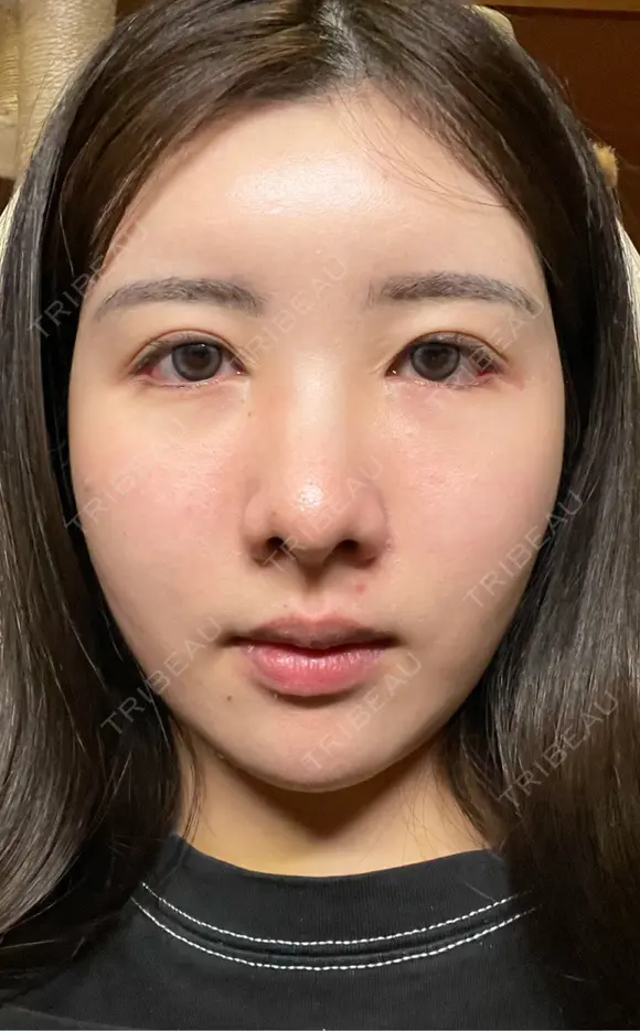 糸リフト / バッカルファット除去 / 脂肪吸引（顔） / 脂肪注入（額） / ジョールファット除去 First Clinic DAY 14 メイン用